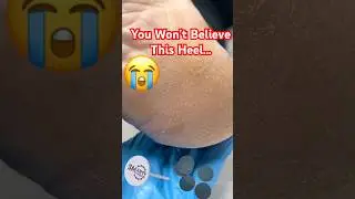 Extreme Callus Removal | Heel Transformation Using SMART Master