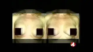 Breast Augmentation and Breast Implant Revision San Francisco Bay Area - 2 of 4