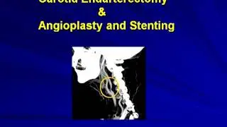 Prevention of First and Recurrent Stroke