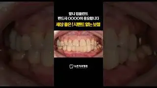 [앞니임플란트] 반드시 OOOO이 중요합니다 세상 좋은 시멘트 없는 보철 #치과