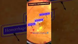 Diabetic retinopathy | Hemorrhages | cotton wool spots | Hard exudates | Fundus | Short Video 131