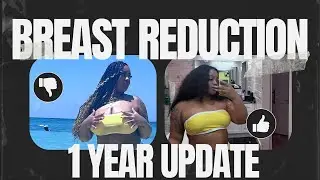 1 Year Breast Reduction Update | The Truth One Year Later