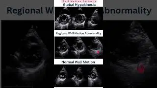 SAX View Interpretation &ndash; Wall Motion Patterns #WallMotion #GlobalHypokinesia #RWMA #LVFunction