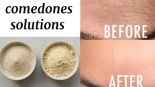 Homemade face mask | closed comedones & acne | in urdu | hindi | @FariaJaved 