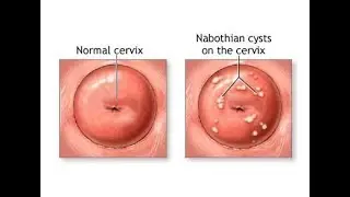 Nabothian Cyst, USG l  Gynae l Obs