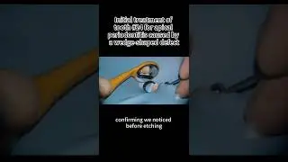 Initial treatment of tooth #24 for apical periodontitis caused by a wedge-shaped defect