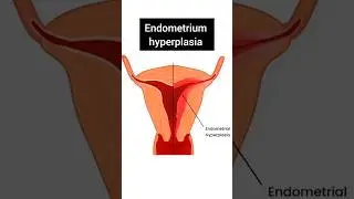 Endometrium hyperplasia #shorts #uterus #heavybleeding