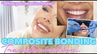 COMPOSITE BONDING, EVERYTHING YOU NEED TO KNOW! | AMY COOMBES