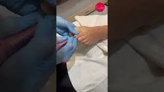 Restauro Piedini 🦶🏻#unghiemania #nails #pedicure #smalto #unghia #foot #estetica #fresa #piedi