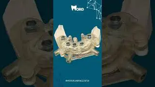 Osteotomia de redu&ccedil;&atilde;o &oacute;ssea para Implantes dent&aacute;rios, feita com precis&atilde;o.