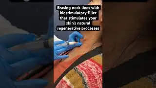 Erasing neck lines with Sculptra #antiaging #sculptra #over40