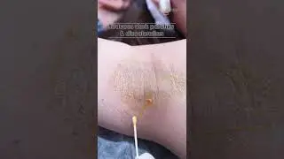 Derma Puritys | Yellow Peel For Underarms Brightening