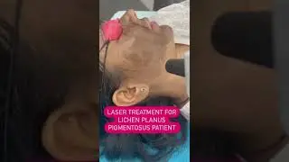 Laser treatment for lichen Planus Pigmentosus Treatment | Dr Ashima Goel|#shorts  #youtubeshorts