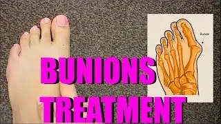 HOW TO TREAT BUNIONS AT HOME?    |SolutionsRoom|