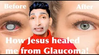 How Jesus healed me from Glaucoma