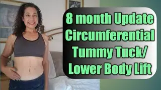 8 Month Post Update Circumferential Tummy Tuck/Lower Body Lift/360 Tummy Tuck