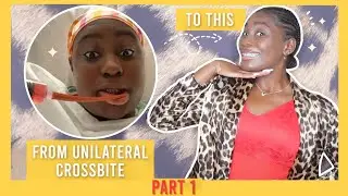WHAT IS AN ANTERIOR OPEN BITE AND HOW DO YOU CORRECT IT?| JAW SURGERY WITH BRACES 🏥