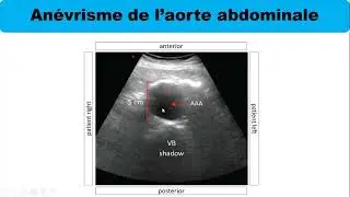 &eacute;chographie d&rsquo;urgence 5:  An&eacute;vrisme de l&rsquo;aorte abdominale