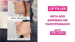 &Upsilon;&alpha;&lambda;&omicron;&upsilon;&rho;&omicron;&nu;&iota;&delta;ά&sigma;&eta; &sigma;&tau;&alpha; &Chi;&epsilon;ί&lambda;&eta; &Pi;&rho;&iota;&nu; &kappa;&alpha;&iota; &Mu;&epsilon;&tau;ά #hyaluronidase #lipfiller