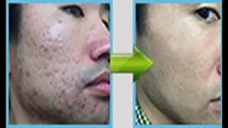 Acne No More Review