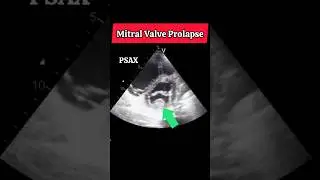 Mitral Valve Prolapse #mitralvalve #prolapse #echo #heart