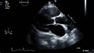 Brown Clinical Image of the Month: Lambls Echo 2
