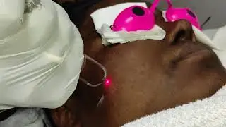 Laser carbon facial