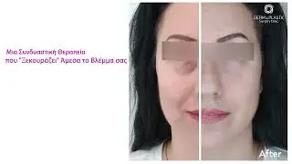 &Upsilon;&alpha;&lambda;&omicron;&upsilon;&rho;&omicron;&nu;&iota;&kappa;ό &sigma;&tau;&alpha; &Mu;ά&tau;&iota;&alpha; &Pi;&rho;&iota;&nu; &kappa;&alpha;&iota; &Mu;&epsilon;&tau;ά #darkcircles 