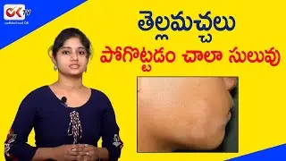 Home Remedies For White Patches On Skin - Causes & Symptoms | Latest Health Tips In Telugu | OkTv