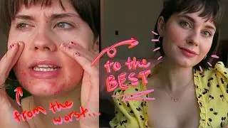 How I Went From the WORST ACNE to the BEST Skin! + My Spring/Summer Daily Makeup Routine🌸