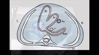 Aberrant Right Subclavian Artery (ARSA) at 13 Weeks | Fetosense @Fetosense_TV 