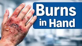 Hand Burn Management and Functional Rehabilitation in Hindi