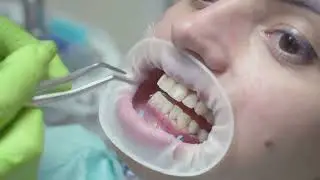The Secret to Perfect Teeth