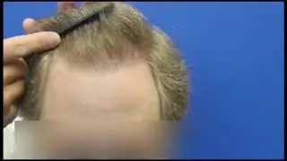 4000 FUE: Nuhair Medical - Hair Transplant Vancouver, Edmonton, Calgary, Winnipeg, Regina