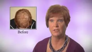 FDA Approved Hair Loss Treatment (Laser Hair Therapy Results)