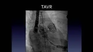 Catheter-Based Ross Replacement Therapy - Dominik Wiktor, MD