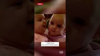 Formerly Conjoined Twins Meet #shorts