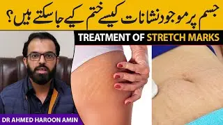 Treatment of Stretch Marks | Dr Ahmed Haroon Amin | Health Matters