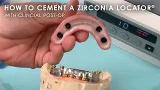How to Cement a Zirconia Locator® with Clinical Post-Op