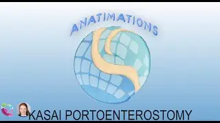 Kasai Portoenterostomy Anatimation