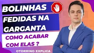 🔥C&aacute;seos Amigdalianos - Acabe com eles AGORA!!!!  Dr.Renato Ponte Otorrino
