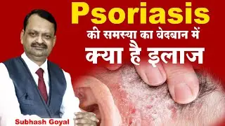 Psoriasis की समस्या का वेदबान में क्या है इलाज ? Subhash Goyal | Sadhna TV