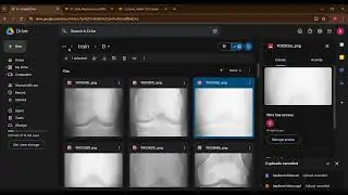 knee osteoarthritis detection project