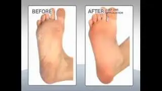 Callous Clear&trade; - Official As Seen On TV Callous Remover Commercial