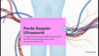 Penile Doppler Ultrasound for Erectile Dysfunction