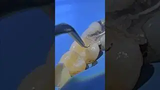 Direct composite restorations using SFRC (GC everX flow + G-aenial sculpt) #biomimetic #dentist