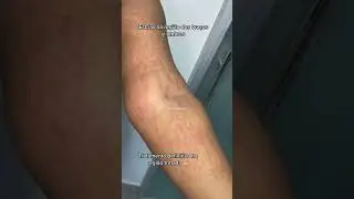 Como acabar com as estrias?