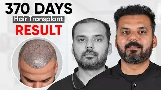 Best Hair Transplant in Kochi (HX-HGDS)  | Best Results & Cost of Hair Transplant in Kochi.