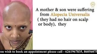alopecia universalis