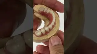 Syton 3500 Hybrid Denture #teeth #dental #smile #lsk121shorts #shortvideo #shorts